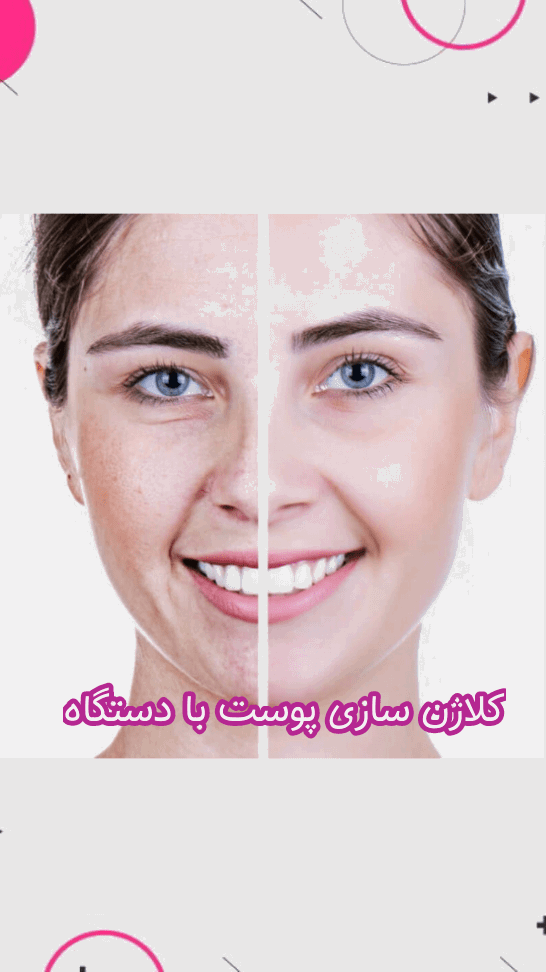 معرفی بهترین روش های کلاژن‌سازی پوست صورت با دستگاه